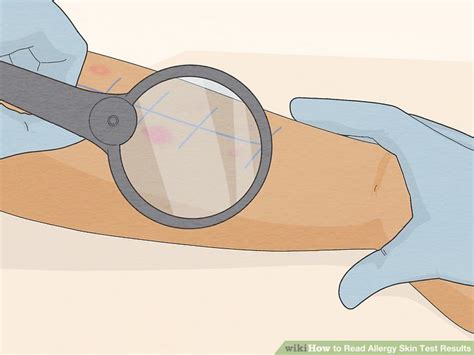 3 Ways To Read Allergy Skin Test Results Wikihow