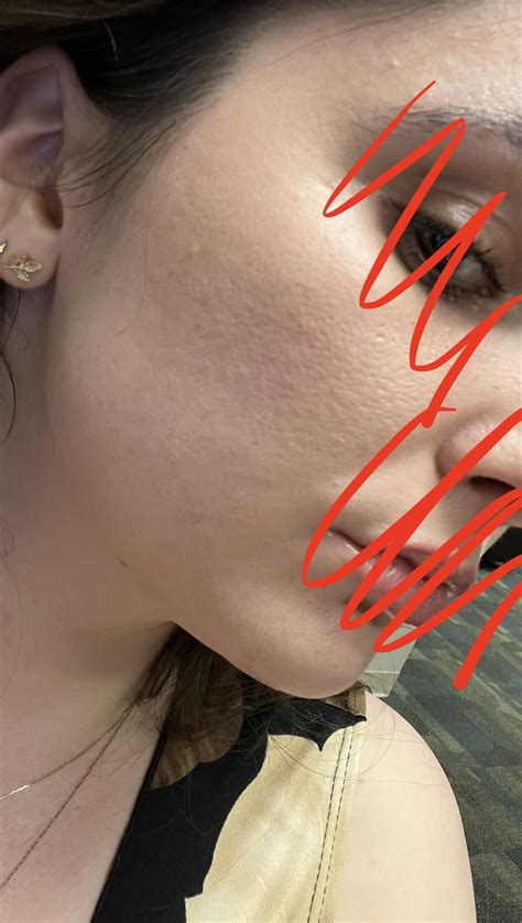 Orange Peel Skin Texture Info In Comments [routine Help] R