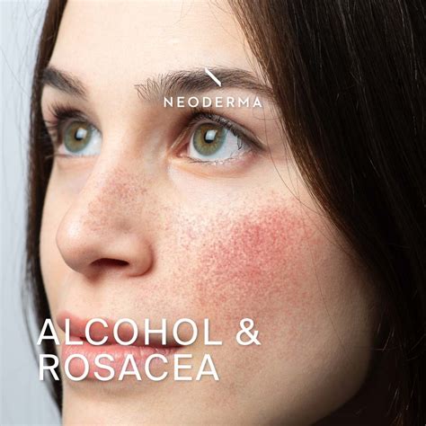 Alcohol And Rosacea Neoderma