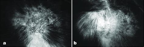 Dramatic Improvement In A Case Of Dissecting Cellulitis Of The Scalp Download Scientific