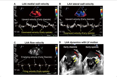 Measurements Of Left Atrial Appendage Laa Function A Medial And