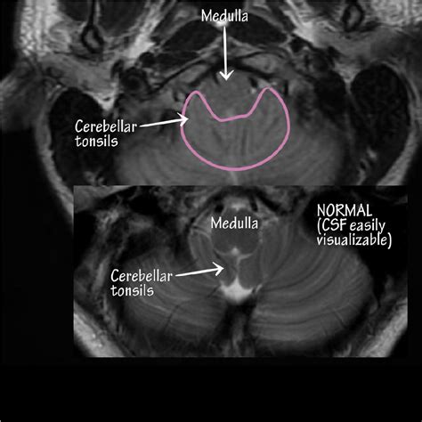 Neuroanatomy Glossary Chiari Malformation Ditki Medical And Biological