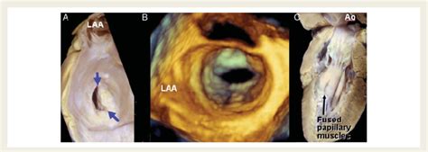 A Specimen Demonstrating Rheumatic Mitral Valve The Leaflets Fuse