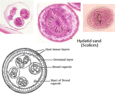 Echinococcus Granulosus Hydatid Cyst