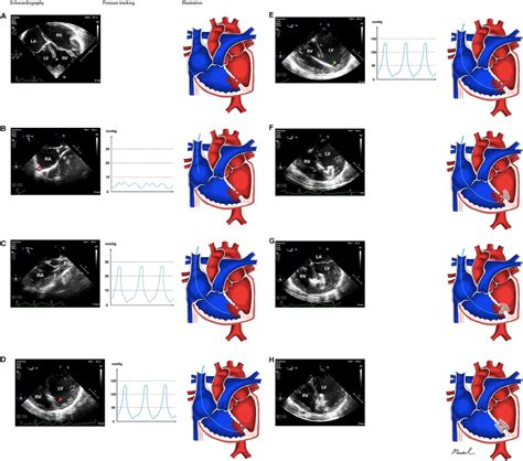 Frontiers Transesophageal Echocardiography Guided Percutaneous