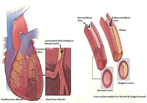 1 Cardiovascular Diseases A Death Of Heart Muscle Leading To Angina