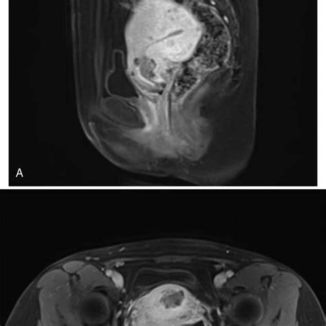 A Sagittal View Of Pelvic Magnetic Resonance Imaging Mri Mri Shows