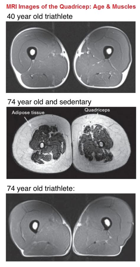 NutritionRx » Age & Muscles: MRI Images of Quadriceps | London ...