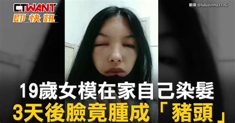 19歲女模在家自己染髮 3天後臉竟腫成「豬頭」 影音 Ctwant