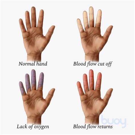 Raynaud's Phenomenon Types How To Treat Raynaud's Buoy, 41% OFF