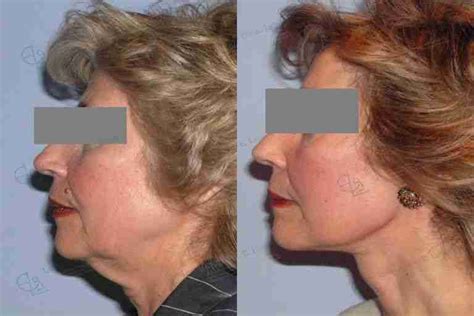 Lifting Facial Con Smas Y Platisma Caso Real Drlalinde