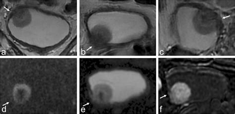 Case Example Of A 67 Year Old Male A Coronal T2wi Showing A