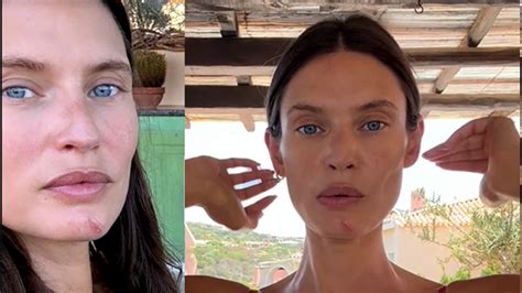 Bianca Balti Ferita Al Mento Racconta Sarebbe Potuta Andare Molto Peggio