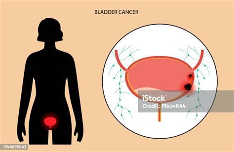 Stadium Kanker Kandung Kemih Ilustrasi Stok Unduh Gambar Sekarang