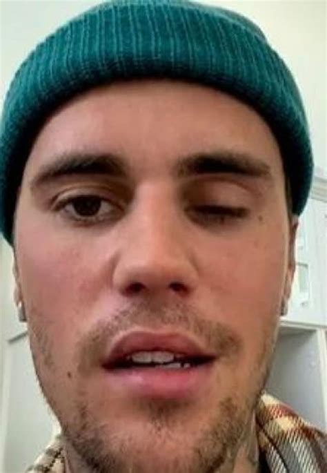 Las Im Genes De La Par Lisis Facial De Justin Bieber Que Le Ha Obligado