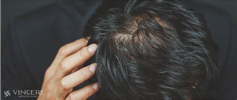 Causes And Treatments For Hair Loss Vincere Aesthetics Clinic Singapore