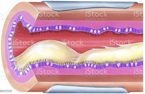 Lungs Bronchial Mucus Causing Airway Obstruction Amp Narrowing Stock