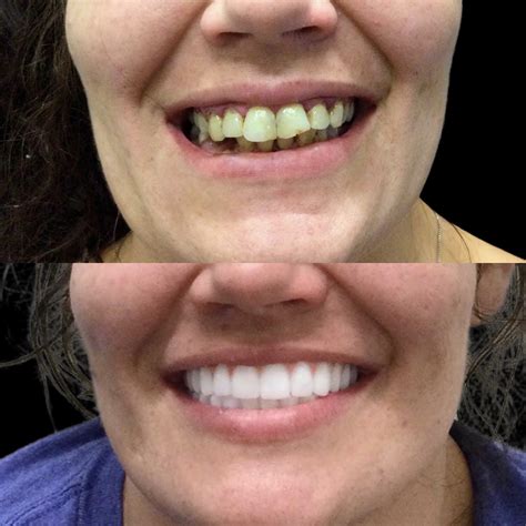 Before And After — Memphis Dentures And Implants