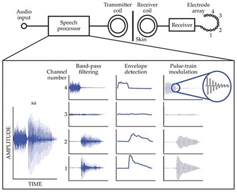 Cochlear Implants And Electronic Hearing Physics Today Aip Publishing