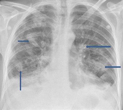 Plain Chest Radiograph Showing Multiple Irregularly Defined Patches Of Download Scientific