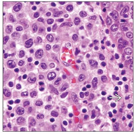 Primary Cutaneous Anaplastic Large Cell Lymphoma | Basicmedical Key