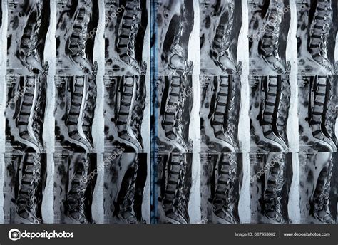 Cairo Egypt November Mri Lumbosacral Spine Revealed Posterior Disc