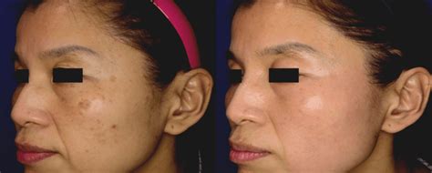 Pico Laser | Laser Treatment | Skin Imperfections | Aesthetic Clinic