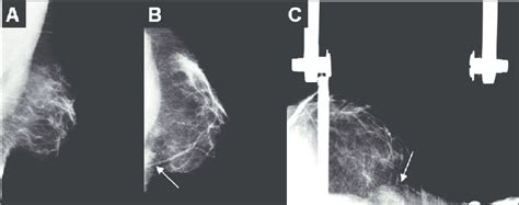 Mamografia Esquerda Sem Evid Ncia De Altera Es Na Incid Ncia