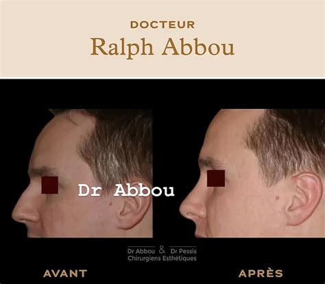 Bosse sur le nez à Paris Rhinoplastie Dr Ralph ABBOU