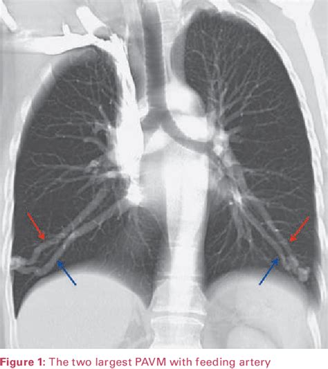 Figure From A Rare Cause Of Paradoxical Embolism Pulmonary