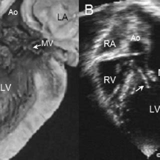 Posterior deviation of the infundibular septum. Specimen of the left ...