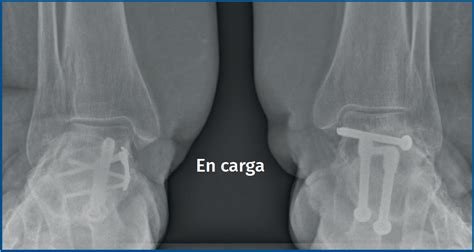 Triple Doble Artrodesis En El Tratamiento Del Pie Plano R Gido Del