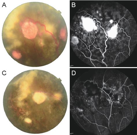 Table 1 From Clinical Results Of Various Treatments For Retinal Capillary Hemangioma Semantic