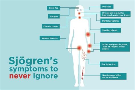 Let’s Know About Primary & Secondary Sjogren Syndrome – Platform | CME