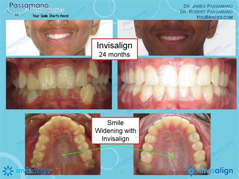 Invisalign Teen Male Expansion Great Smile Passamano Orthodontics