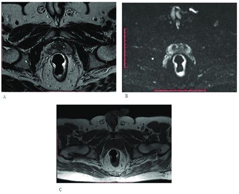 Multiparametric Magnetic Resonance Imaging Mri Of Prostate A Axial