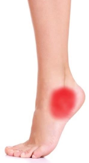 Tendonitis On Outer Side Of Foot Flash Sales