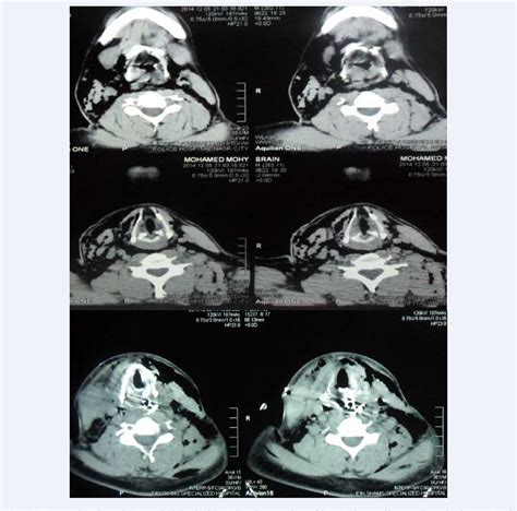 Figure 1 from The Use of Autologous Fascia Lata Graft Aided with ...