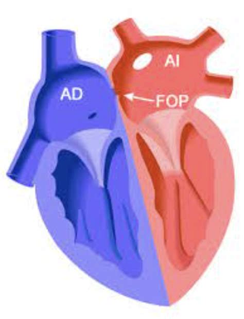 Tengo Un Foramen Oval Permeable Y Ahora Qu Uicar