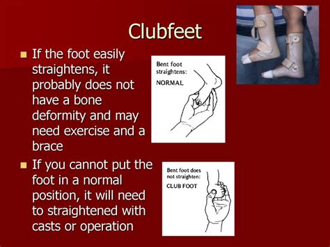 Club Feet Observations And Possible Solutions Ppt Download