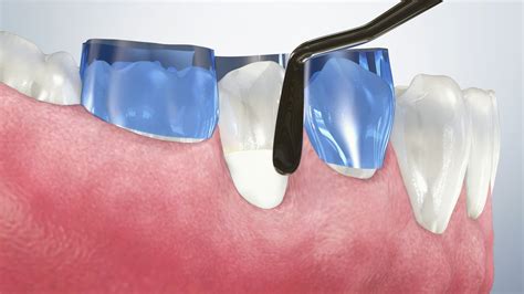 Golden Peak Dental Educational Videos NCCL Abfraction Composite