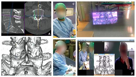 Frontiers Augmented Reality In Medical Practice From Spine Surgery To Remote Assistance