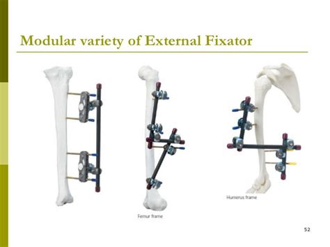 External fixator