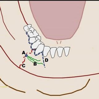 Diagram Showing Vestibular Incision A Mental Foramen B Mental