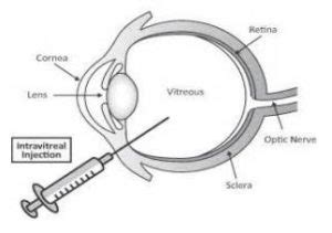 Intravitreal Injection Milton Keynes University Hospital