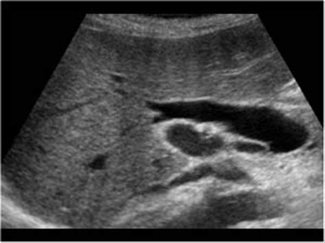 Abdomen And Retroperitoneum 12 Gallbladder And Bile Ducts Case 12