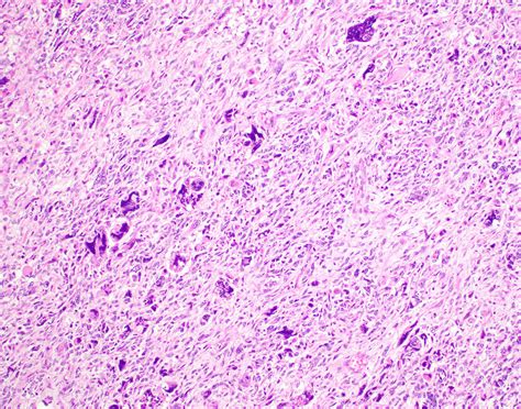 Pathology Outlines Undifferentiated Uterine Sarcoma