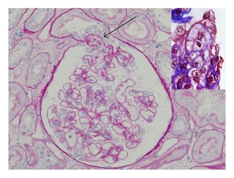 Tip Variant Of Fsgs Foam Cell Accumulated Segment Prolapsed Into The