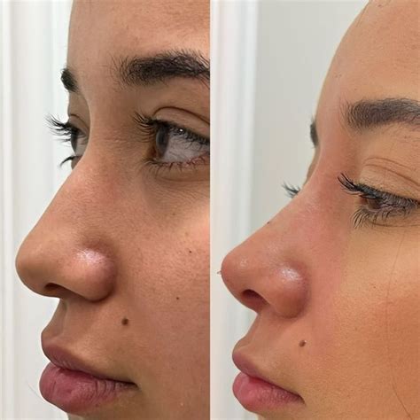 Liquid Rhinoplasty Bliss Med Spa And Wellness