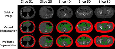 Deep Learning Based Quantification Of Abdominal Subcutaneous And